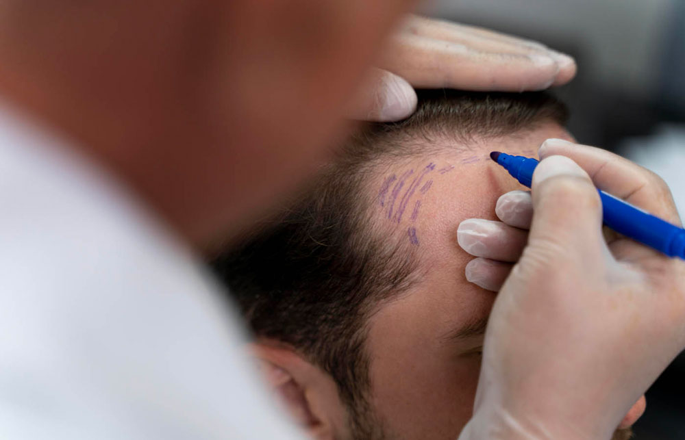 Male Hair Transplantation