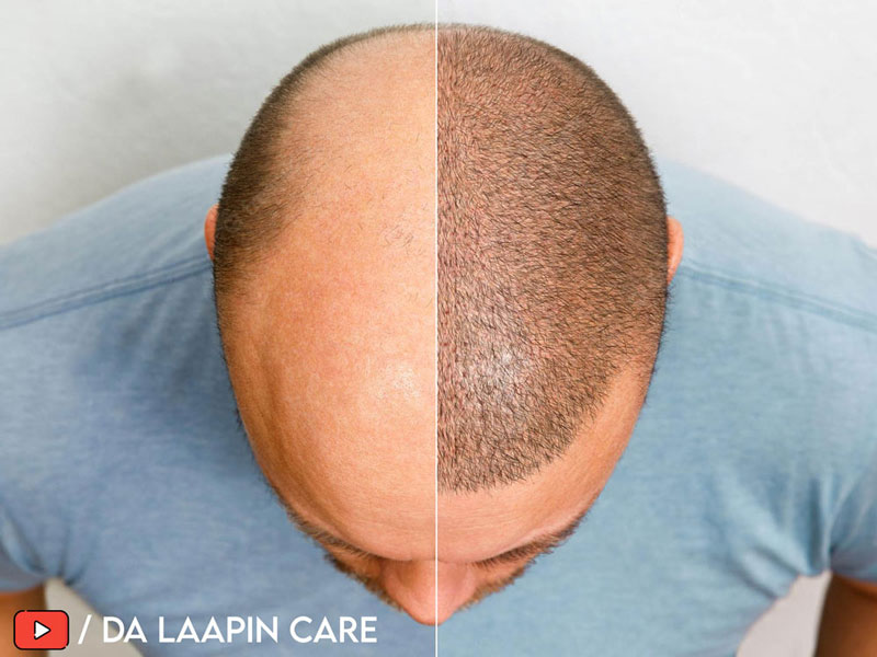 da laapincare youtube thumbnail